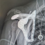 Innovation chirurgicale : l’implant sur mesure